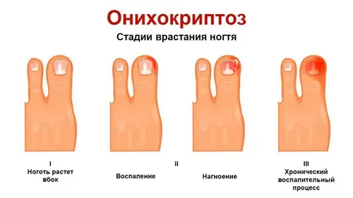 Onychokryptozy etapy wrastania paznokci